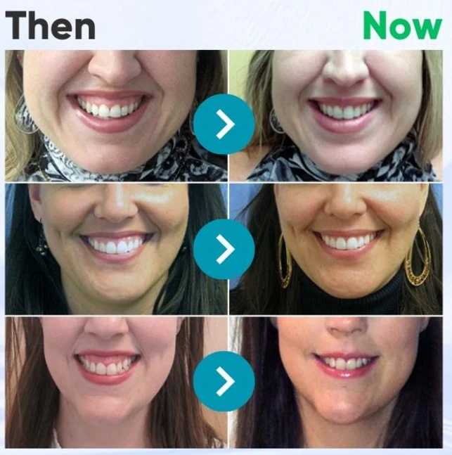 ⭐️𝐅𝐮𝐫𝐳𝐞𝐫𝐨® 𝐅𝐨𝐜𝐮𝐬𝐬𝐦𝐢𝐥𝐞 𝐛𝐞𝐞 𝐯𝐞𝐧𝐨𝐦 𝐭𝐫𝐞𝐚𝐭𝐦𝐞𝐧𝐭 𝐩𝐨𝐰𝐝𝐞𝐫 𝐟𝐨𝐫 𝐨𝐫𝐚𝐥 𝐮𝐬𝐞🦷