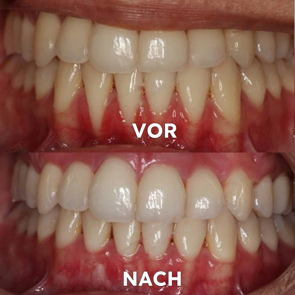 ✅Offizieller Shop | Ourlyard® 🦷Mundgesundheits-Mineralpulver🦷