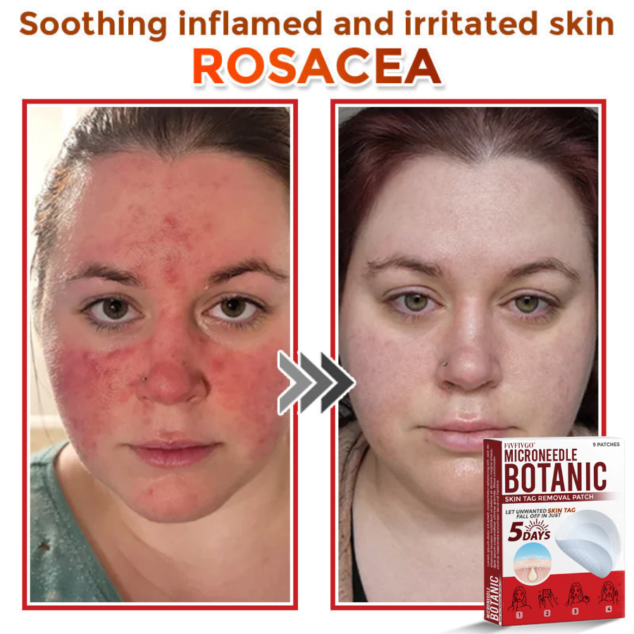 Fivfivgo® MicroNeedle Botanic Skin Tag Removal Patch 🇺🇸 Made in the USA